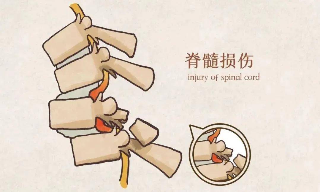 最新脊髓治疗观点论述与进展探索