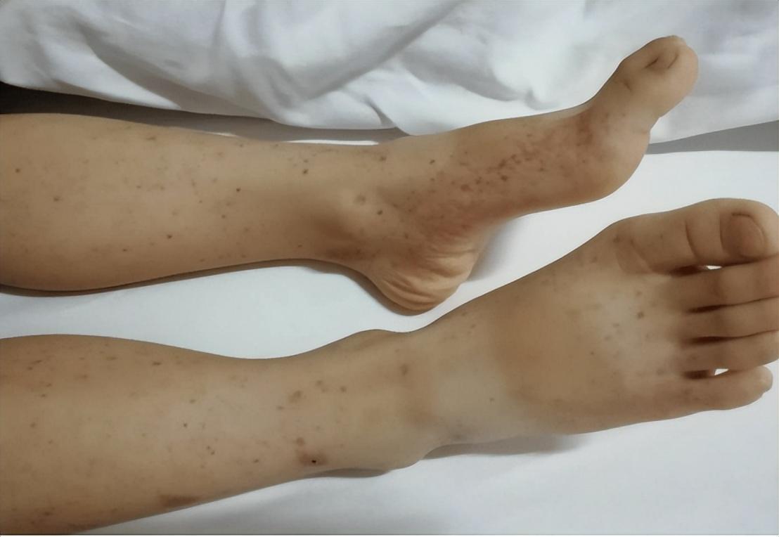 肺炎例数最新监测神器,科技守护健康,革新生活品质监测报告