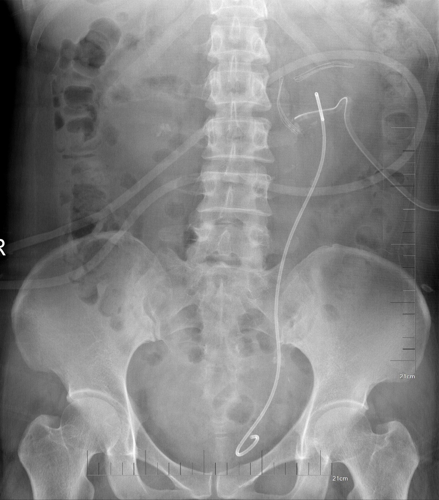 幻肢痛最新治疗方法研究及进展