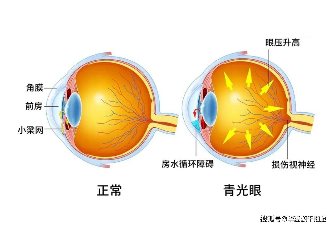 视网膜再生疗法最新进展,视网膜再生疗法最新进展，步骤指南
